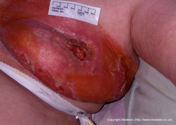 malignant breast following radiotherapy